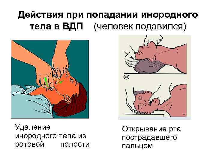 Действия при попадании инородного тела в ВДП (человек подавился) Удаление инородного тела из ротовой