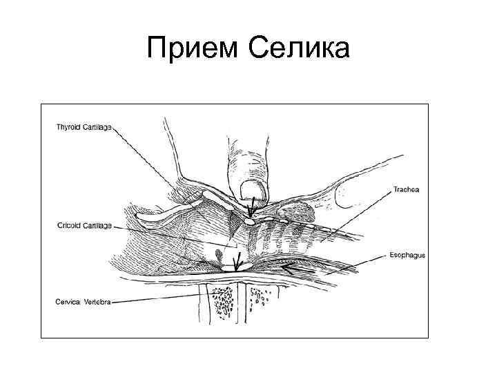 Прием Селика 