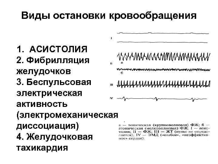 Адреналин фибрилляция желудочков