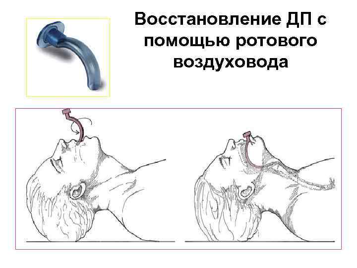 Острая дыхательная недостаточность у детей презентация