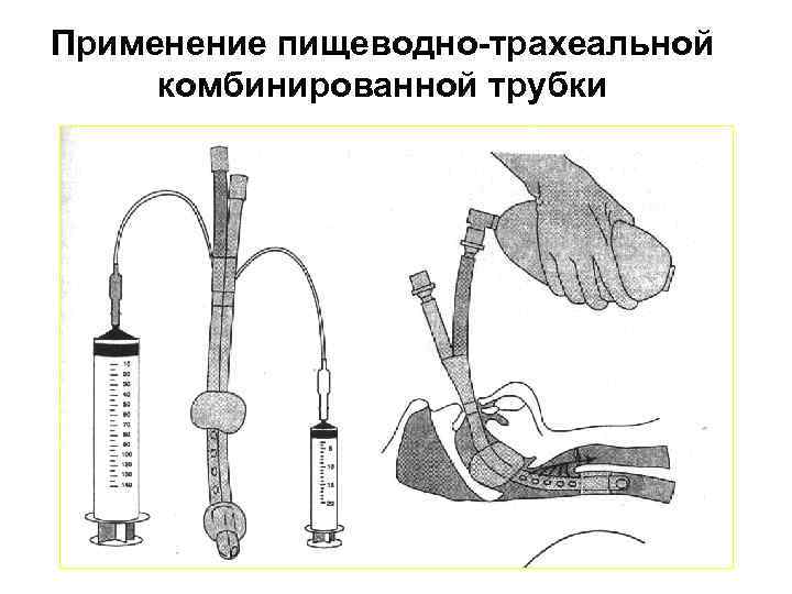 Применение пищеводно-трахеальной комбинированной трубки 