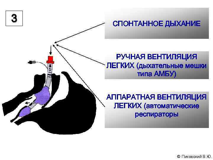 Острая дыхательная недостаточность картинки для презентации