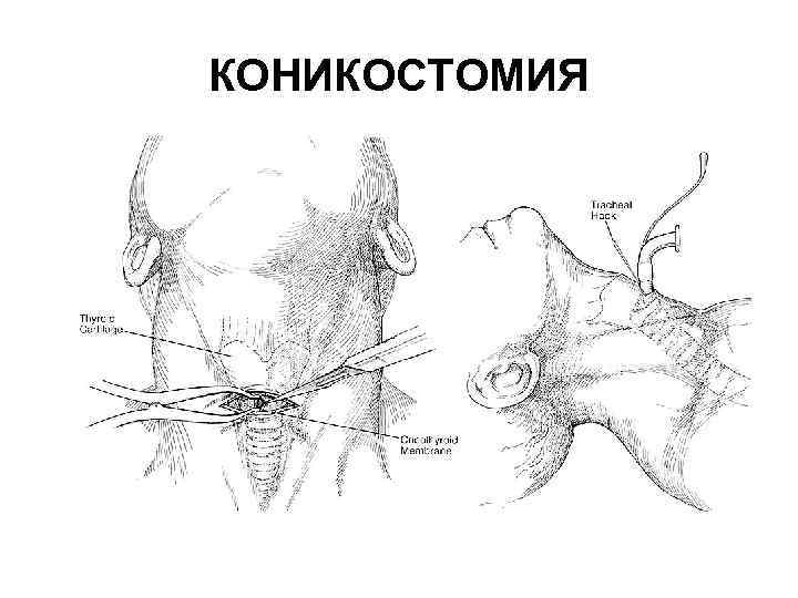 КОНИКОСТОМИЯ 