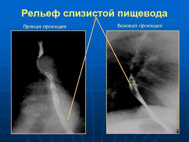 Лучевая диагностика пищевода презентация