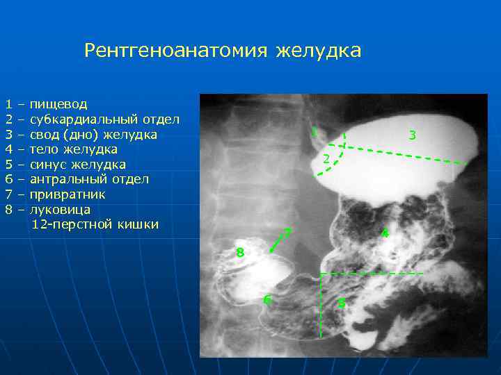 Клиническая картина острой кишечной непроходимости