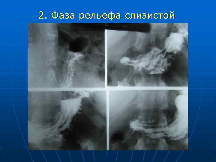 2. Фаза рельефа слизистой 