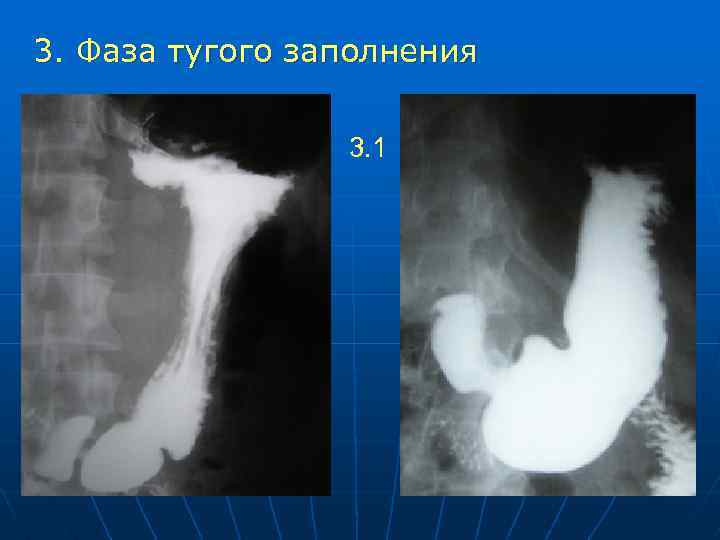 3. Фаза тугого заполнения 3. 1 