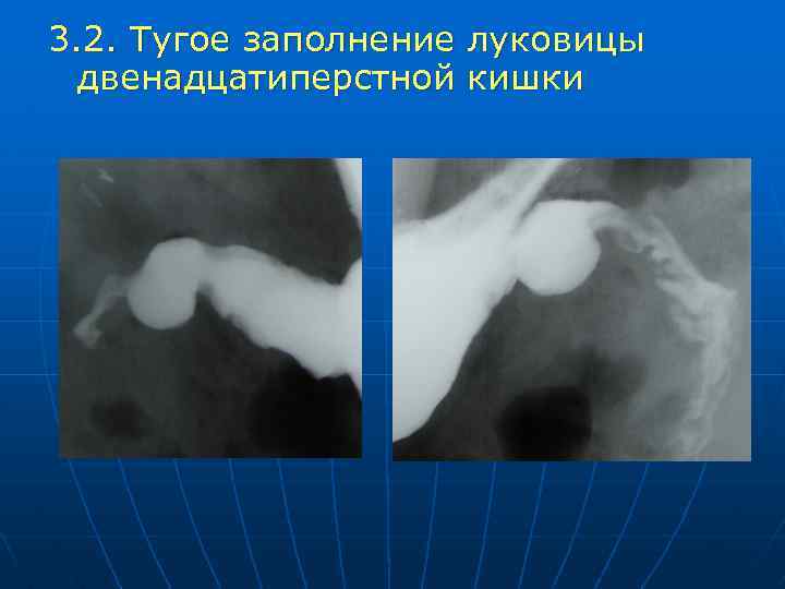 3. 2. Тугое заполнение луковицы двенадцатиперстной кишки 