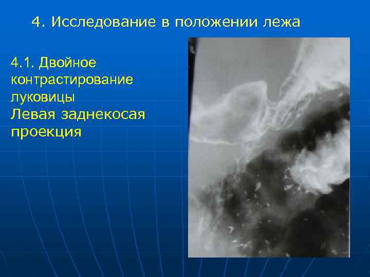 4. Исследование в положении лежа 4. 1. Двойное контрастирование луковицы Левая заднекосая проекция 