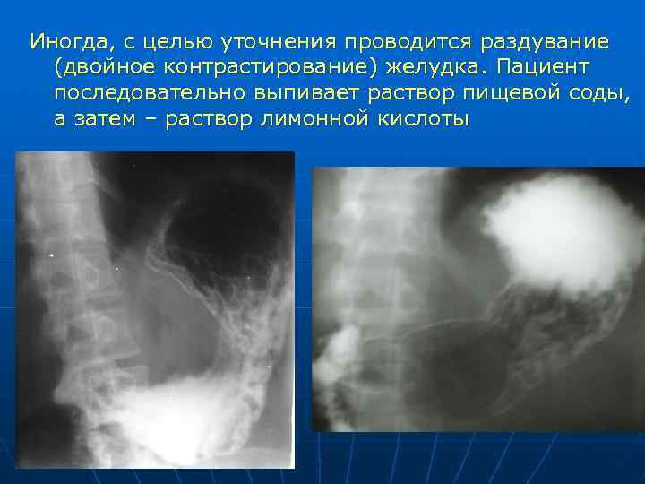 Лучевая диагностика жкт презентация