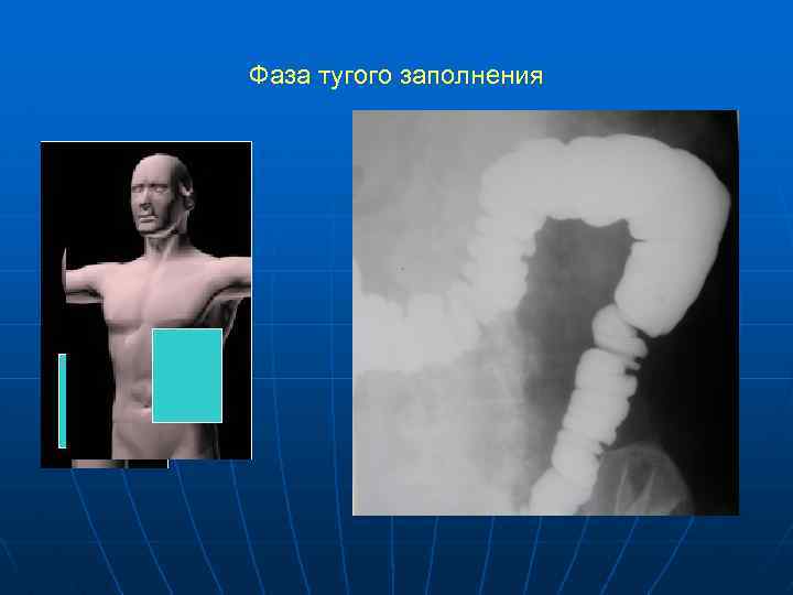 Фаза тугого заполнения 