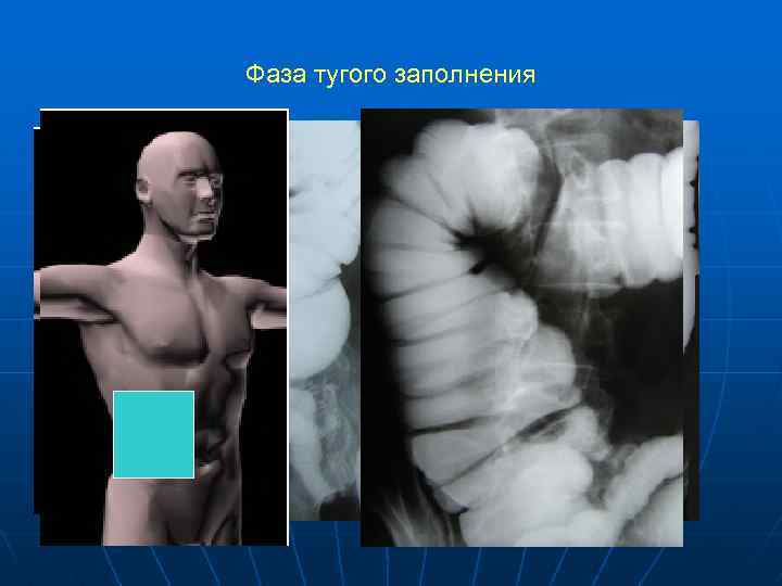 Фаза тугого заполнения 