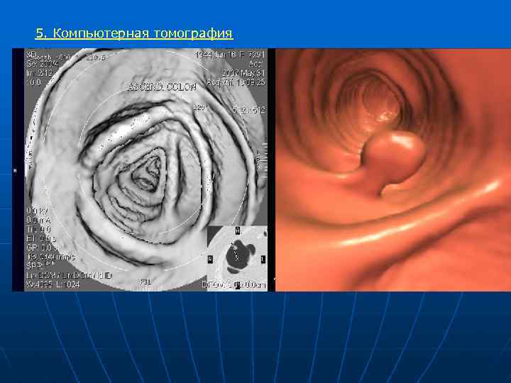 5. Компьютерная томография 