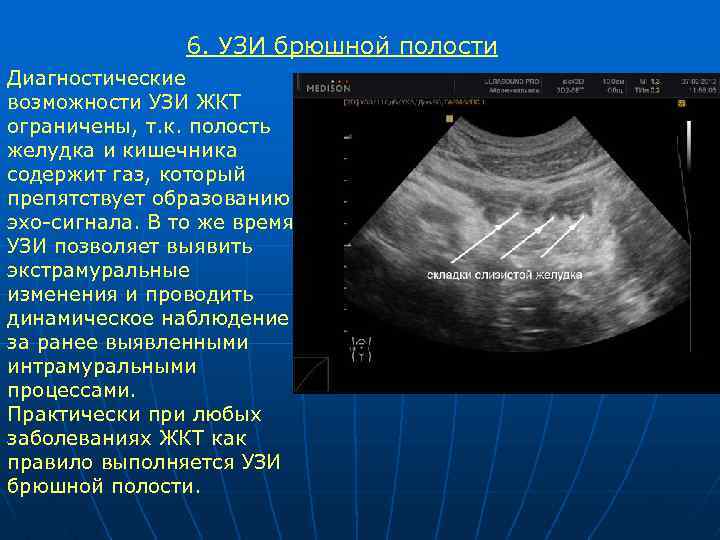 6. УЗИ брюшной полости Диагностические возможности УЗИ ЖКТ ограничены, т. к. полость желудка и
