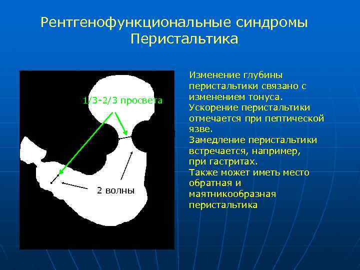 Рентгенофункциональные синдромы Перистальтика 1/3 -2/3 просвета 2 волны Изменение глубины перистальтики связано с изменением