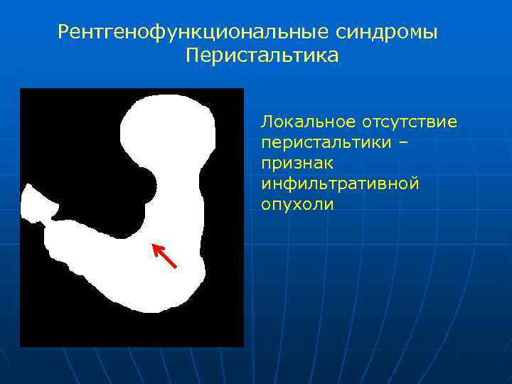 Рентгенофункциональные синдромы Перистальтика Локальное отсутствие перистальтики – признак инфильтративной опухоли 