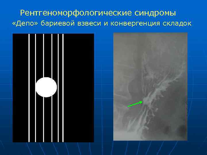 Рентгеноморфологические синдромы «Депо» бариевой взвеси и конвергенция складок 