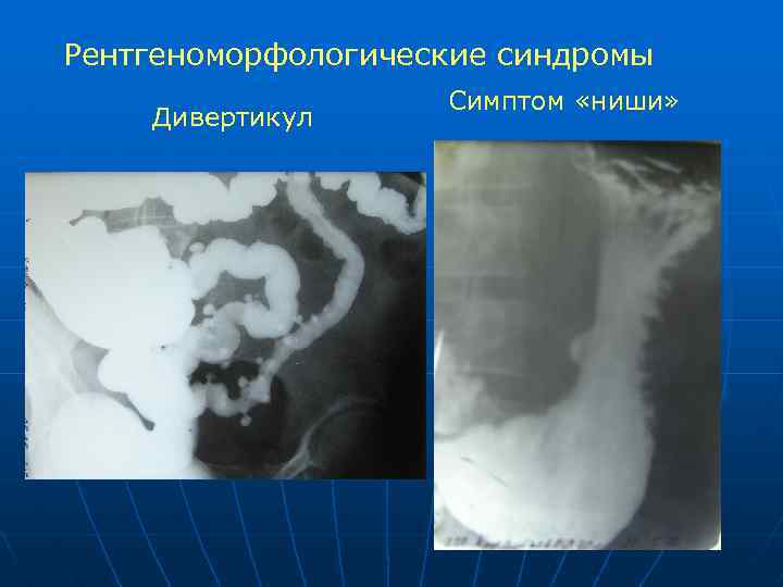 Рентгеноморфологические синдромы Дивертикул Симптом «ниши» 