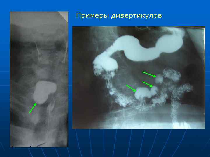 Примеры дивертикулов 