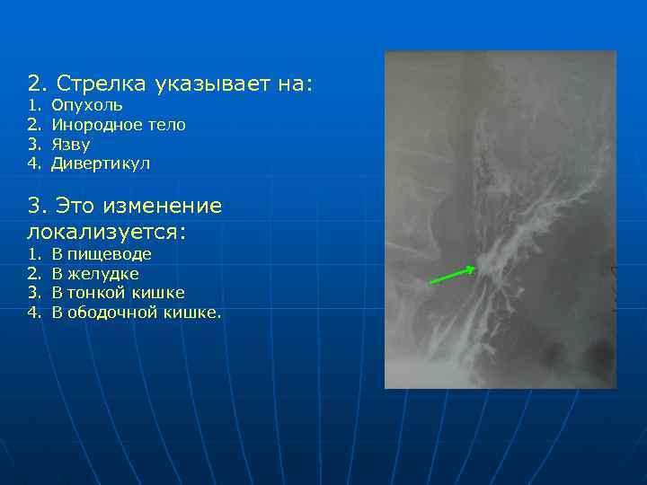 2. Стрелка указывает на: 1. 2. 3. 4. Опухоль Инородное тело Язву Дивертикул 3.
