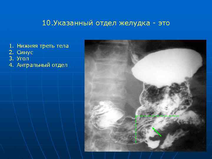 10. Указанный отдел желудка - это 1. 2. 3. 4. Нижняя треть тела Синус
