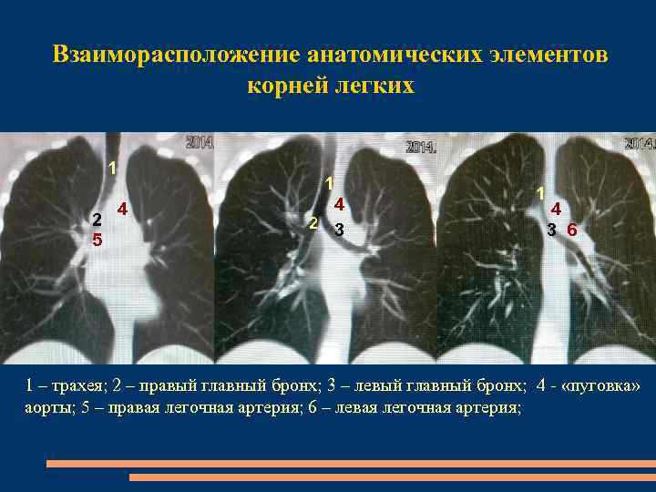 Взаиморасположение анатомических элементов корней легких 1 2 5 1 4 4 2 3 1