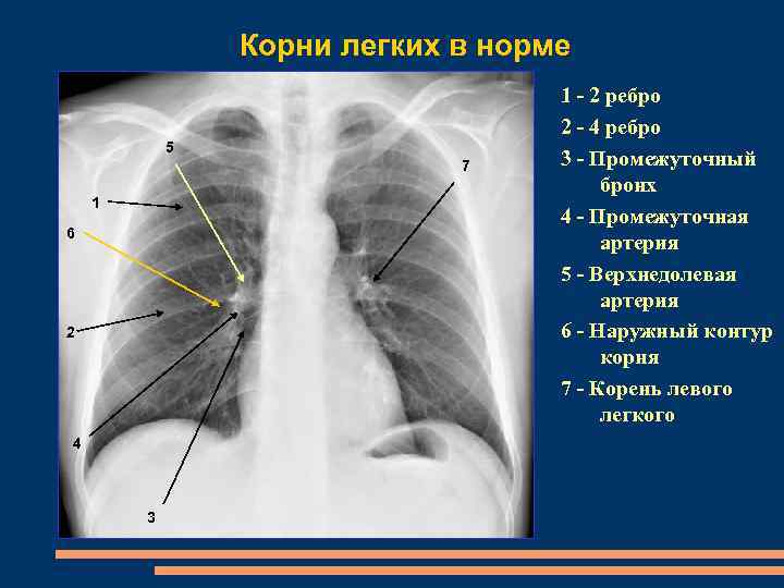 Корень легкого. Корни легких в норме на рентгенограмме. Корень легкого в норме на рентгене. Корень легкого на рентгенограмме в норме. Корни легких на рентгене в норме.