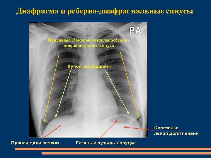 Реберно диафрагмальный синус