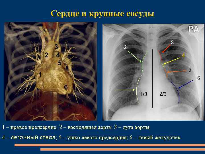 Сердце и крупные сосуды 3 2 4 5 1 6 6 1 1/3 2/3