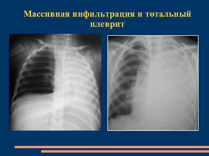 Массивная инфильтрация и тотальный плеврит 