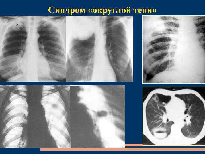 Синдром «округлой тени» 