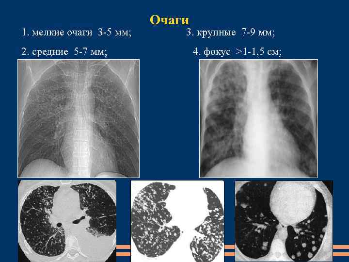 1. мелкие очаги 3 -5 мм; Очаги 2. средние 5 -7 мм; 3. крупные