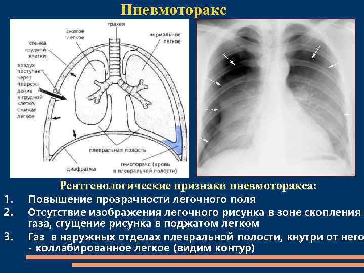 Рентген картина пневмоторакса