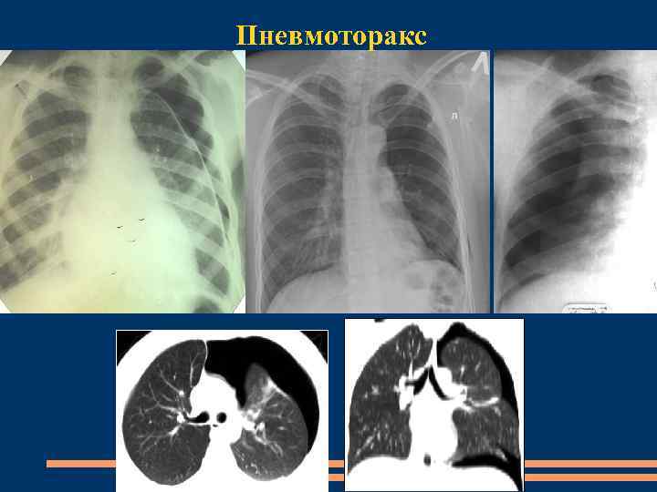 Пневмоторакс 