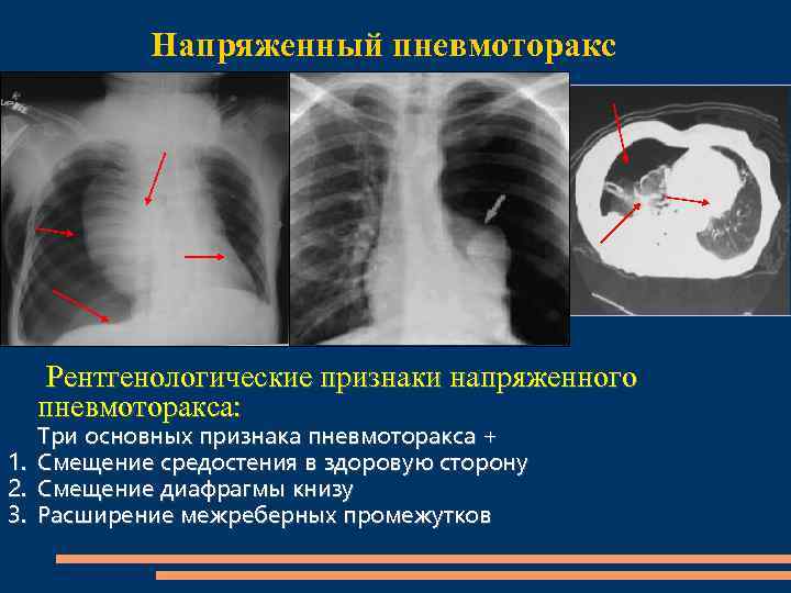 Карта смп пневмоторакс