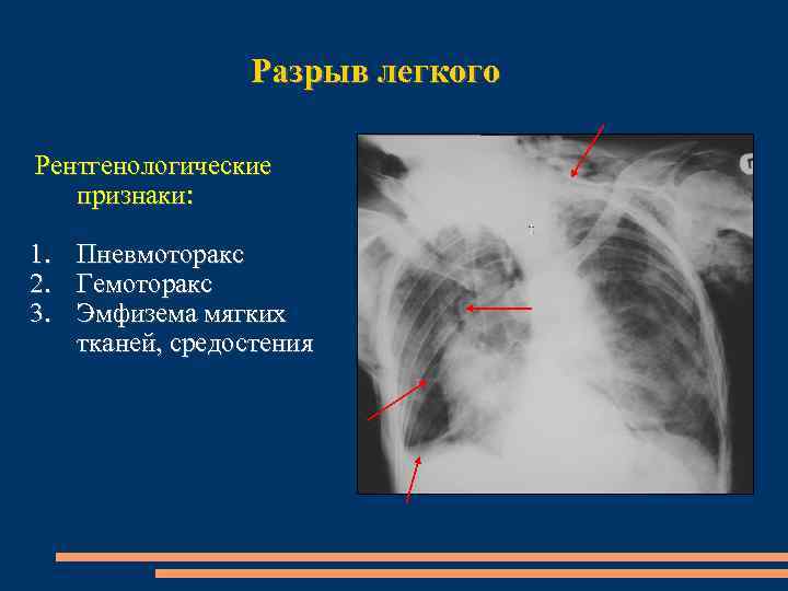 Критерии структурности легочного рисунка