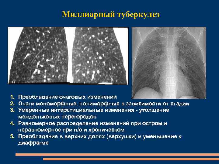 Миллиарный туберкулез 1. Преобладание очаговых изменений 2. Очаги мономорфные, полиморфные в зависимости от стадии