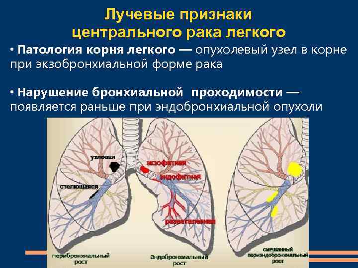 Клиническая картина рака легкого