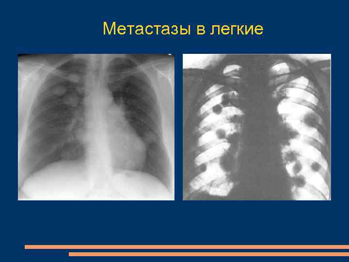 Как выглядят метастазы в легких на рентгене у человека фото