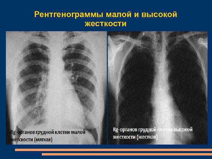 Рентгенограммы малой и высокой жесткости 