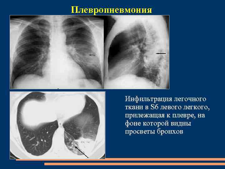 Локальное сгущение легочного рисунка