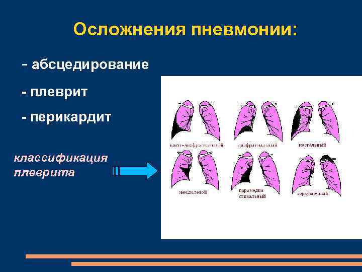 Осложнения пневмонии: - абсцедирование - плеврит - перикардит классификация плеврита 