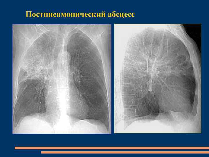 Постпневмонический абсцесс 