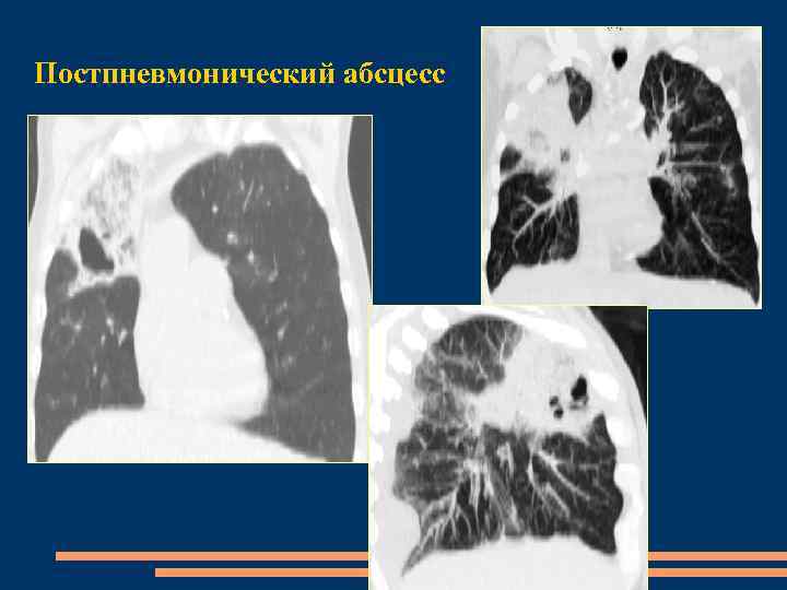 Постпневмонический абсцесс 