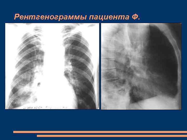Рентгенограммы пациента Ф. 