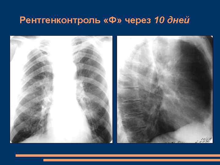 Рентгенконтроль «Ф» через 10 дней 