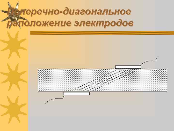 Поперечно-диагональное раположение электродов 