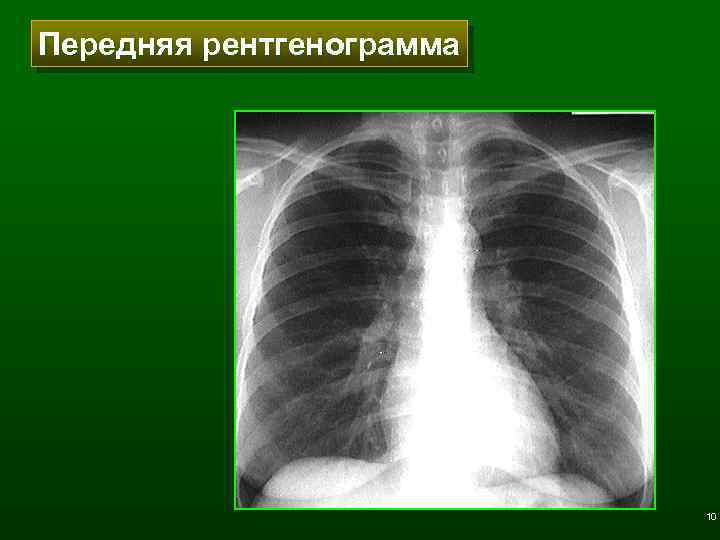 Передняя рентгенограмма 10 