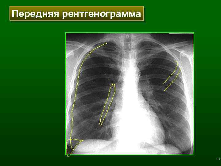 Передняя рентгенограмма 11 