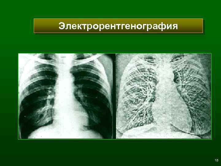Электрорентгенография 15 